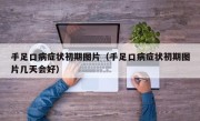 手足口病症状初期图片（手足口病症状初期图片几天会好）